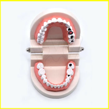 Zobni Študija, Poučevanja Zob Model Karies Zob Skrbi Za Izobraževanje Zobozdravnik Oprema