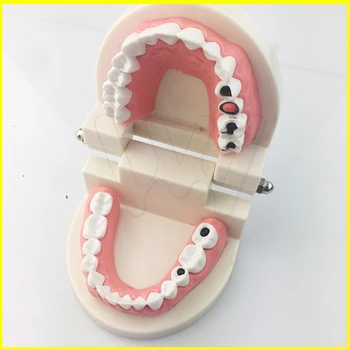 Zobni Študija, Poučevanja Zob Model Karies Zob Skrbi Za Izobraževanje Zobozdravnik Oprema