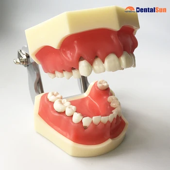 Zobni Periodontal Disease Model M4024/Zdravstveni Zob Medicinski Model